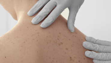 doctor checking a patient's skin on the back