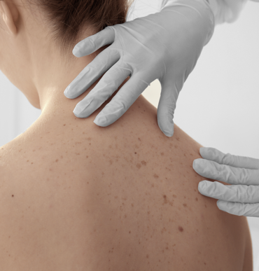 doctor checking a patient's skin on the back