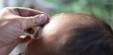 closeup of a man with hair loss