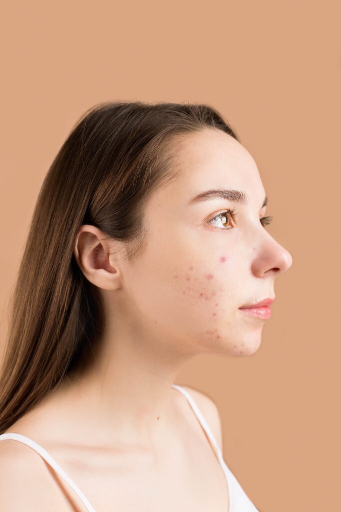 Girl on profile position showing acne scars