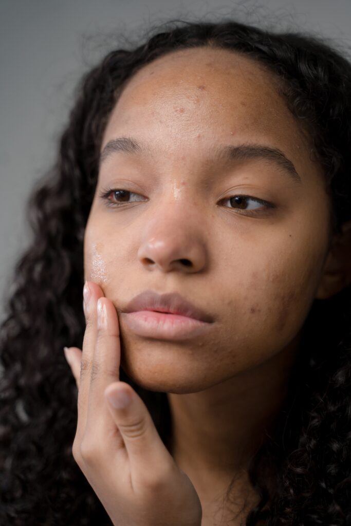 Girl with hand on the face with light acne scars