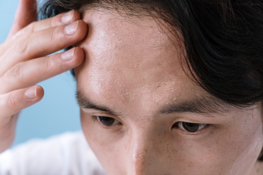 Patient with eczema marks on the forehead