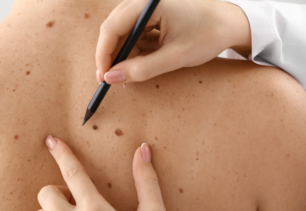 Dermatologist applying marks onto patient's skin before moles removal, closeup