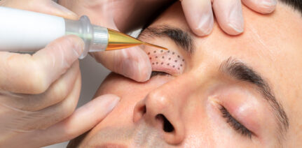 Close up macro detail of middle aged man having skin tightening on eyelids with laser plasma pen.