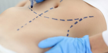 Doctor plastic surgeon drawing preoperative markings on skin of patient abdomen closeup. Plastic surgery and aesthetic medicine liposuction concept