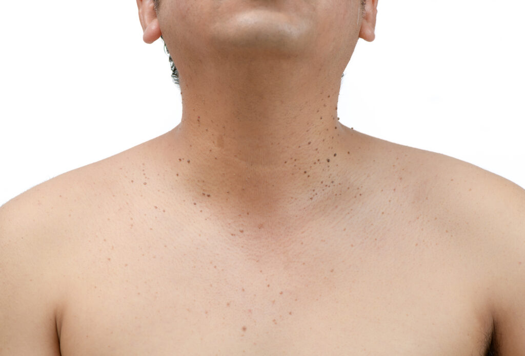 Closed up the skin tags or Seborrheic Keratosis on neck man isolated on white background.Health care concept