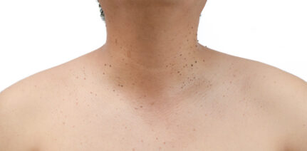 Closed up the skin tags or Seborrheic Keratosis on neck man isolated on white background.Health care concept