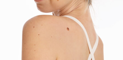 Woman with birthmark on her back, skin. Checking benign moles. Skin tags removal
