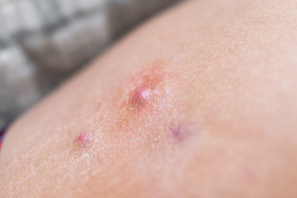 Macro closeup of red swollen boil pimple on leg skin of female woman showing medical condition called hidradenitis suppurativa
