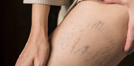 Aging of the legs skin. The appearance of veins and cellulite. Venous disease - varicose veins. A woman takes care of her legs. Close-up vertical photo