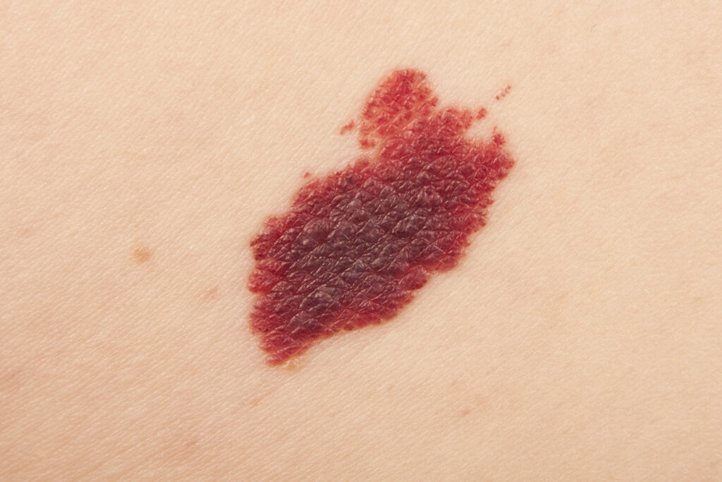 Angioma on a woman back.