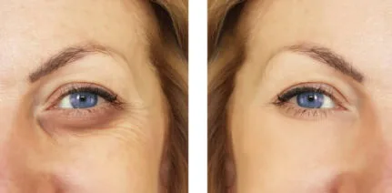 woman, eye swollen before and after procedures
